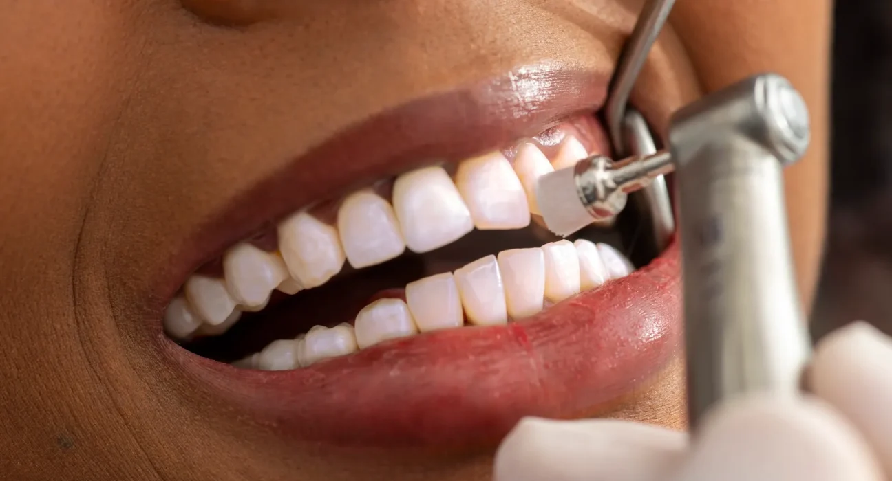 Restauration dentaire définitive en une seule séance : des chercheurs dévoilent une technologie révolutionnaire
