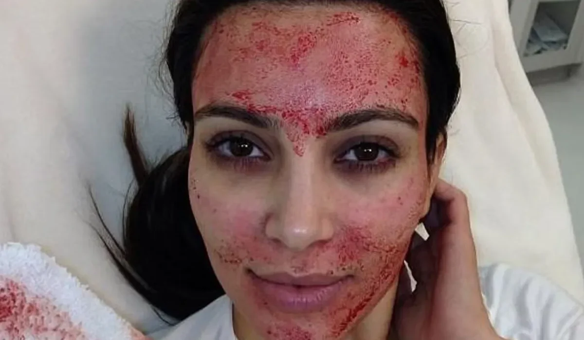 Des Femmes Diagnostiquées Positives au VIH Suite à des Procédures de "Vampire Facial" Rendues Célèbres par Kim Kardashian.