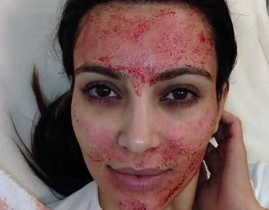 Des Femmes Diagnostiquées Positives au VIH Suite à des Procédures de "Vampire Facial" Rendues Célèbres par Kim Kardashian.