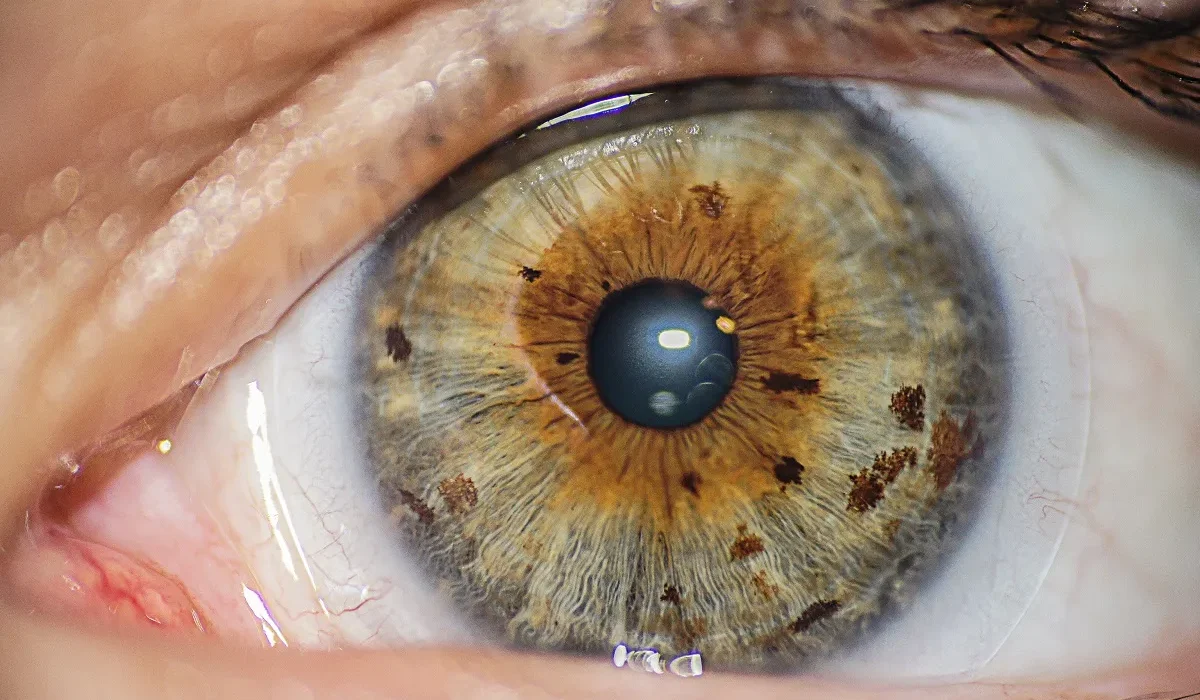 Des Médecins Propulsent l'Injection d'Or dans les Yeux comme Solution à la Perte de Vision
