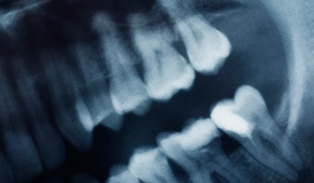 Des Scientifiques Cultivent des Dents Vivantes comme Alternatives aux Implants Dentaires.