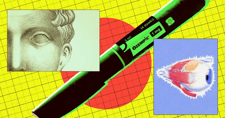 Des Signes Croissants Indiquent un Lien Entre l'Ozempic et la Cécité.