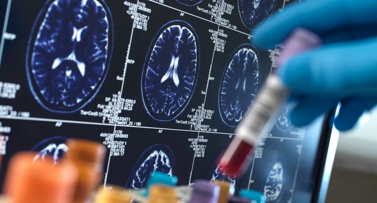 Implants Neuralink : Le deuxième sujet en témoigne, le premier patient déclare une diminution des performances