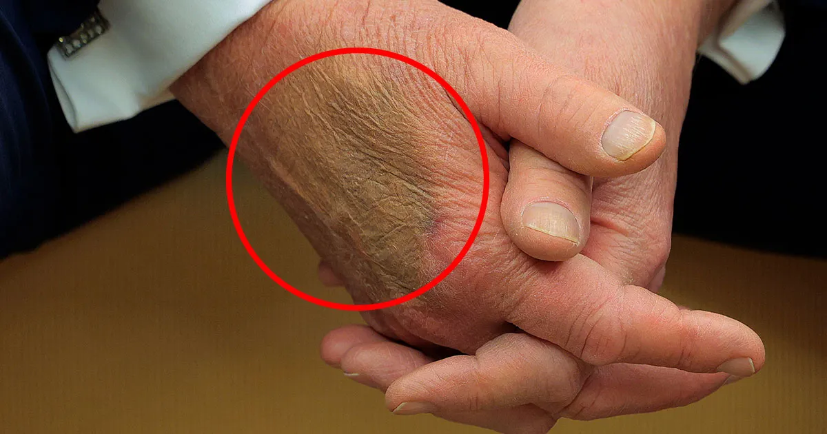 L'Empreinte Mystérieuse sur la Main de Trump