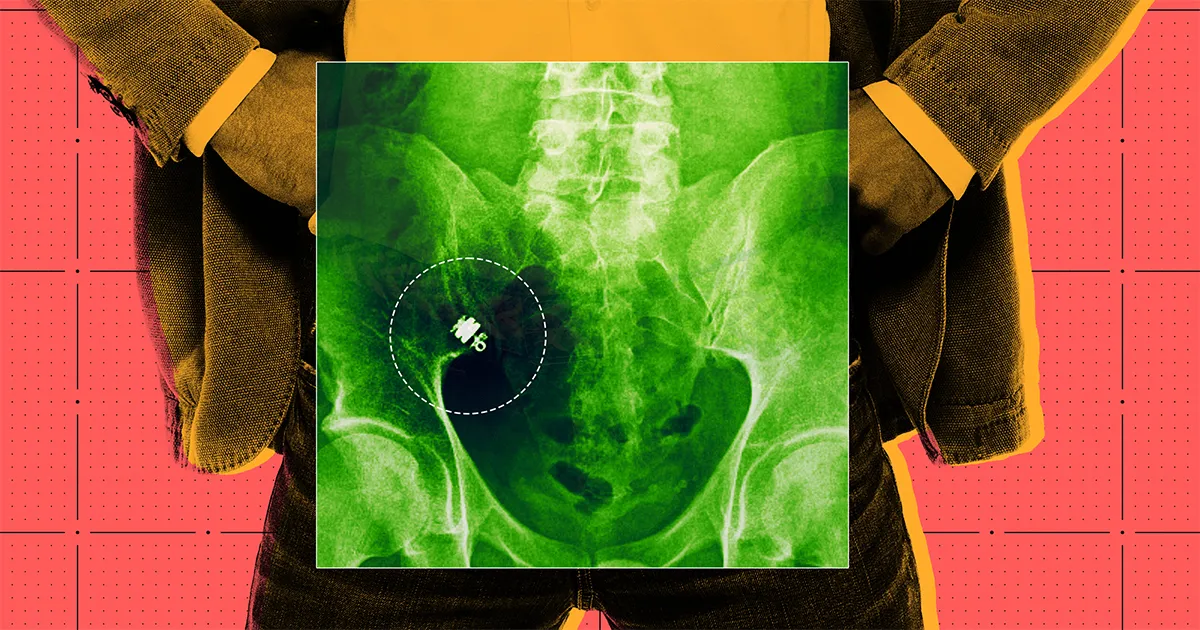 Rencontrez l'homme dont la pilule high-tech est restée coincée dans ses intestins pendant six mois — et qui affirme qu'elle lui a sauvé la vie.