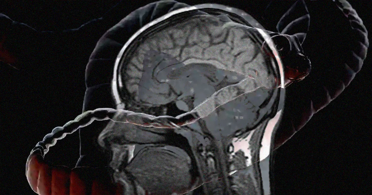 Des Médecins Étonnés de Découvrir un Ver Solitaire dans le Cerveau d'un Homme