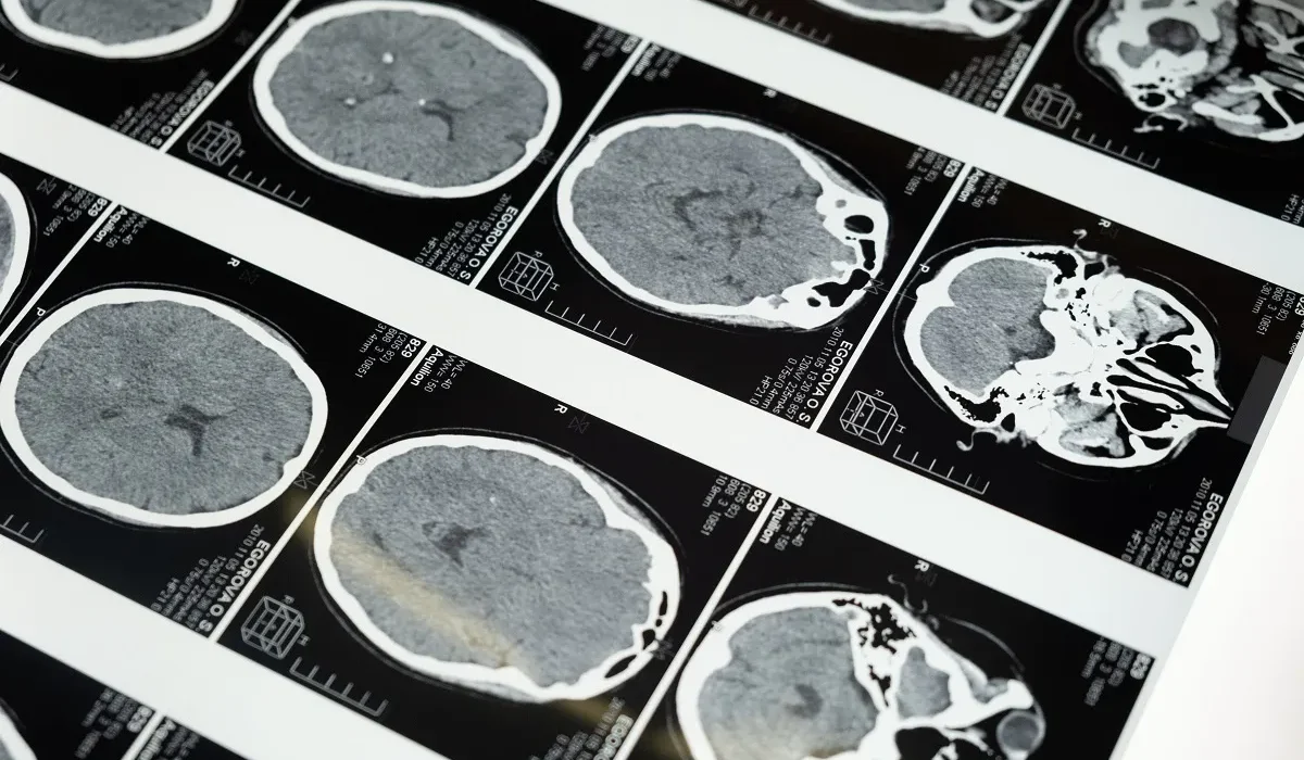 Des décennies de recherche sur l'Alzheimer fondées sur des données présumées falsifiées.