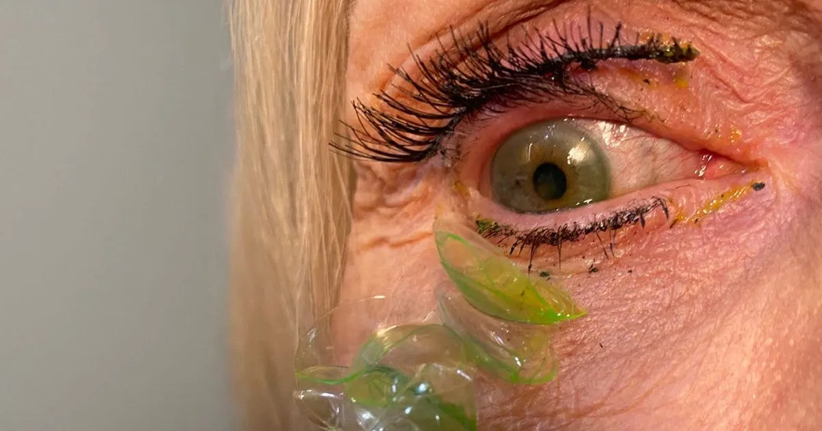 Dramatique Vidéo : Un Médecin Retire 23 Lentilles de Contact de l'Œil d'un Patient.