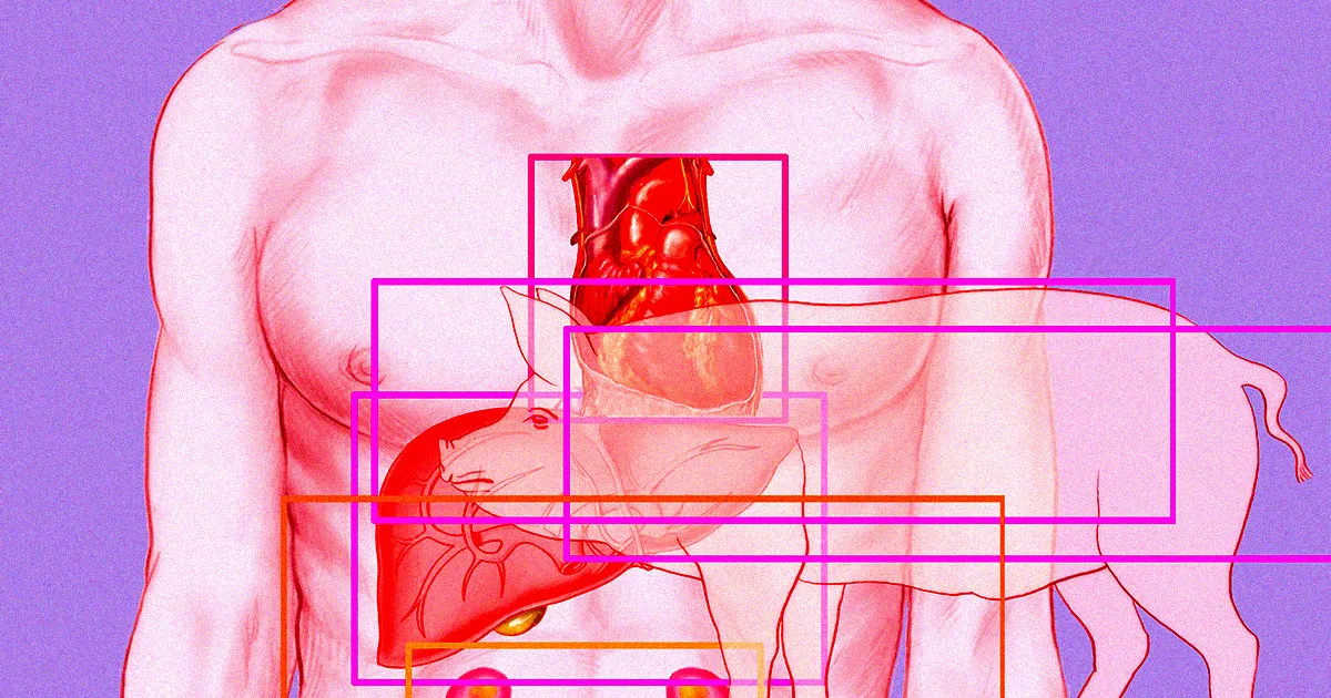 Presse Sous Critique : Un Patient au Cœur de Porc Modifié Impliqué dans un Incident Violent du Passé