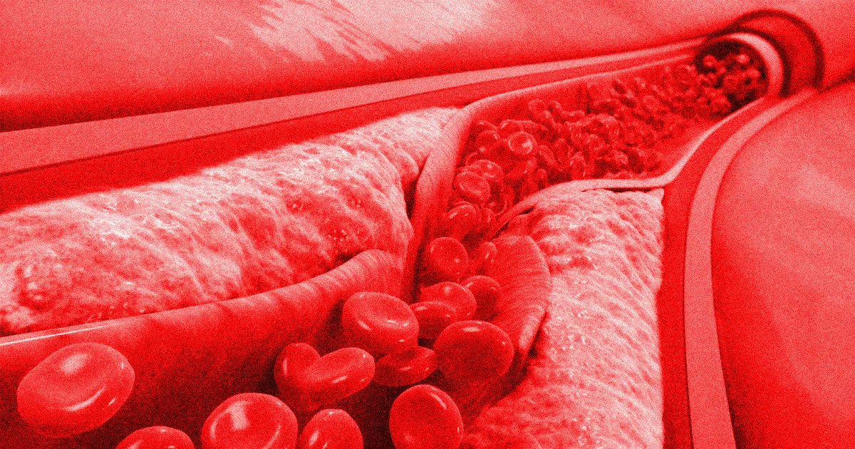 AstraZeneca Répond aux Inquiétudes sur les Caillots Sanguins Liés à son Vaccin COVID