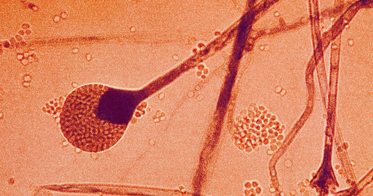 Inquiétude parmi les médecins face à l'épidémie de "Fongus Noir" affectant le cerveau des patients.