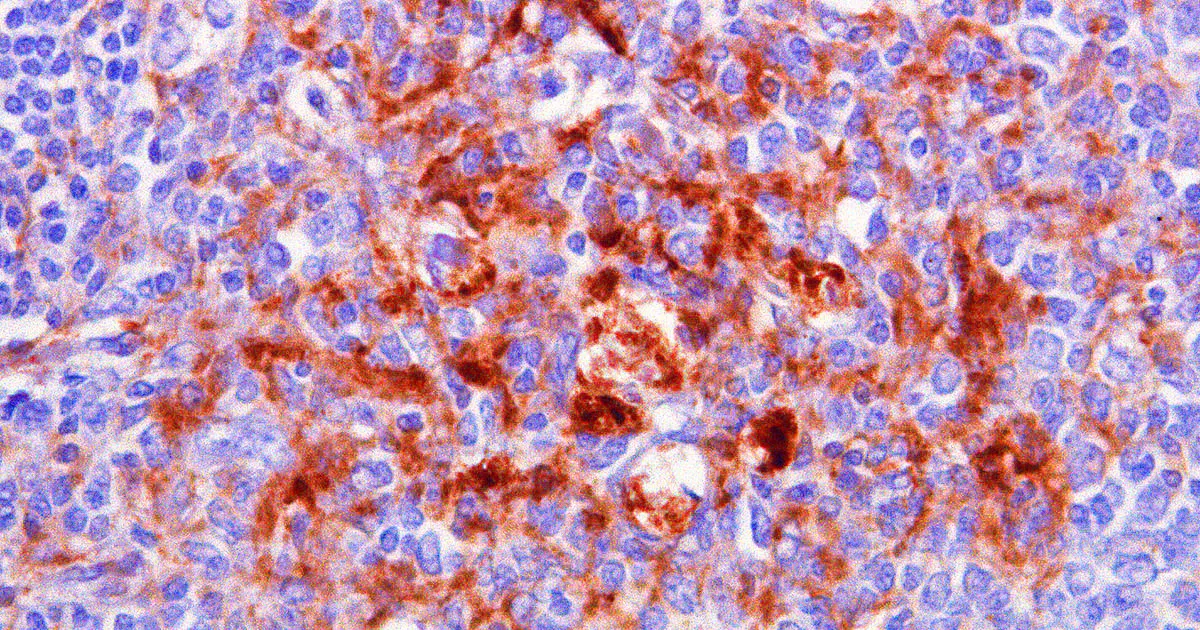 « Le Vieillissement de la Population Japonaise et la Montée d'une Maladie Cérébrale Rare »