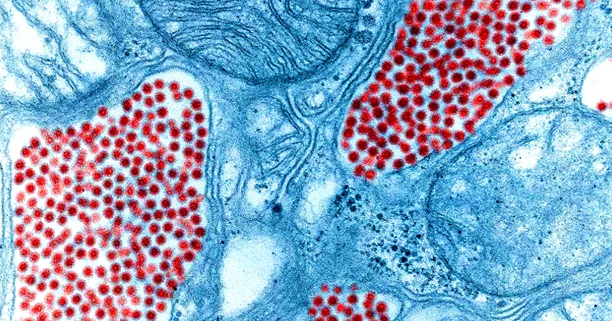 Alerte Sanitaire : Un Nouveau Virus Mortel Se Propage aux États-Unis
