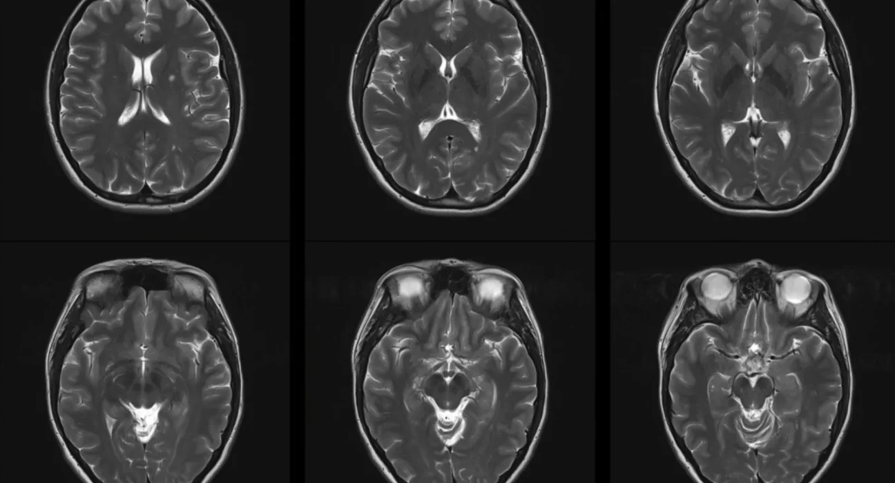 Des chercheurs alertent sur le risque accru de sclérose en plaques dû à l'exposition prolongée à la pollution de l'air.