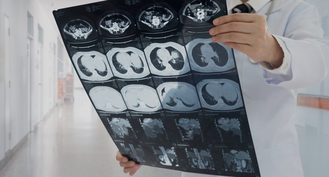 Des chercheurs découvrent un facteur méconnu lié aux lésions rénales : 'Peut compromettre la santé cellulaire globale'