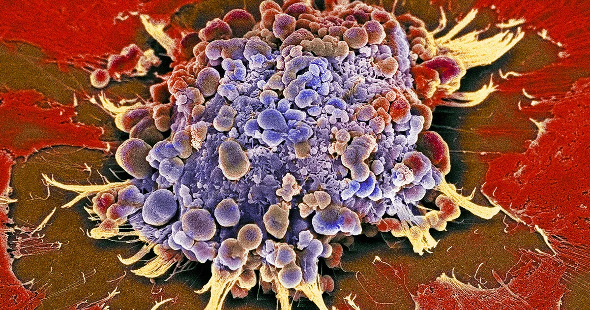 Des scientifiques dévoilent un médicament anticancéreux révolutionnaire qui affame les cellules tumorales