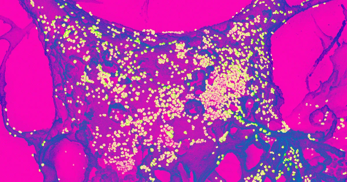 Une Description Choc d'une Infection Grave au Coronavirus