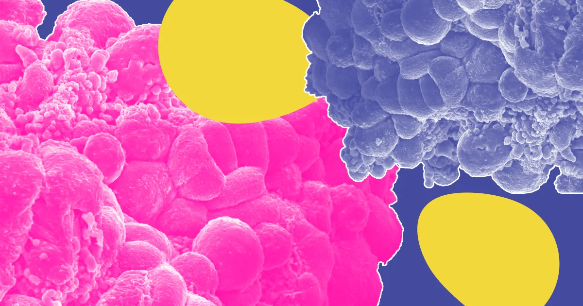 Cancer : Une Multiplicité de Facteurs au-delà du Bacon et des Téléphones Portables