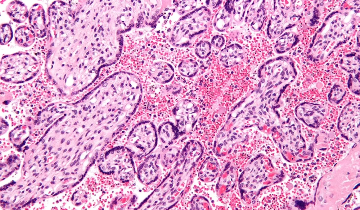 Des Bactéries Intestinales Errantes Pourraient Être à l'Origine de Maladies Comme le Lupus.