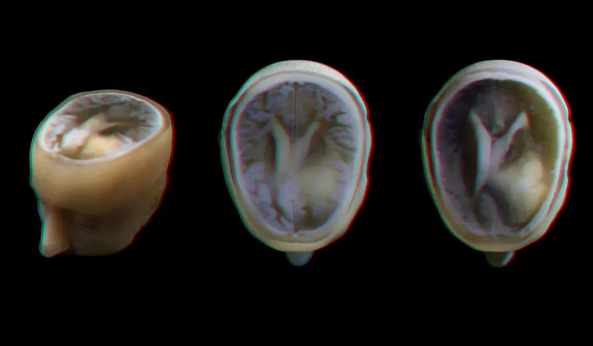 Des Modèles Céramique 3D Ultra Précis des Cerveaux Patientèles Disponibles.