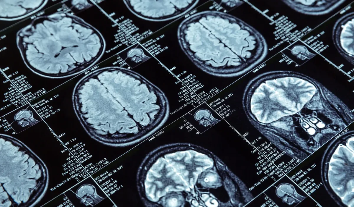 Implantation d'un Pacemaker Cérébral : Une Nouvelle Voie pour Traiter l'Addiction aux Opioïdes