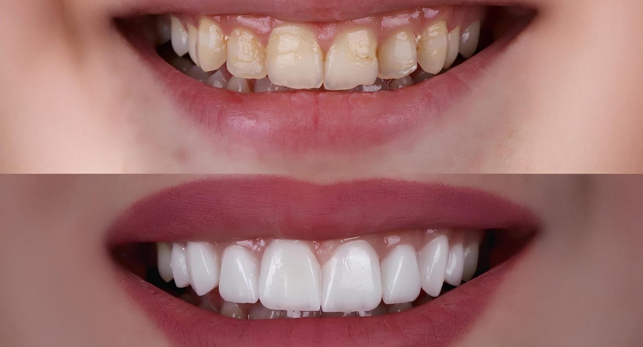 La Perle Rare de la Dentisterie : Une Technologie Révolutionnaire pour Transformer la Réparation Dentaire.