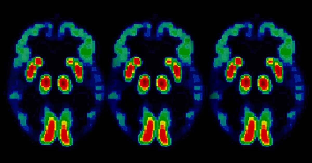 Une Nouvelle Thérapie Prometteuse pour Freiner la Perte de Mémoire due à l'Alzheimer.