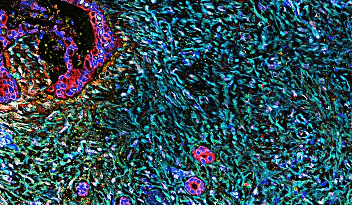 Des Déchets Cellulaires Transformés en Traitement Potentiel du Cancer du Pancréas