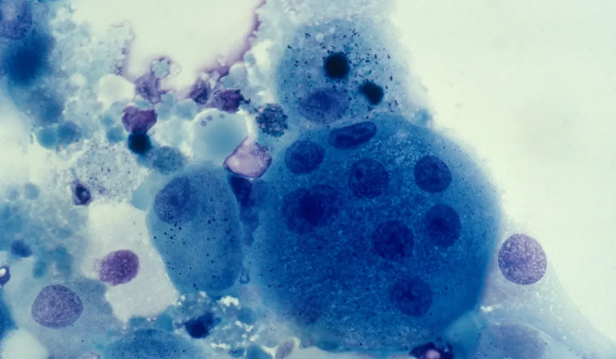 « Des scientifiques annoncent qu’un enfant a été “virtuellement guéri” du VIH »