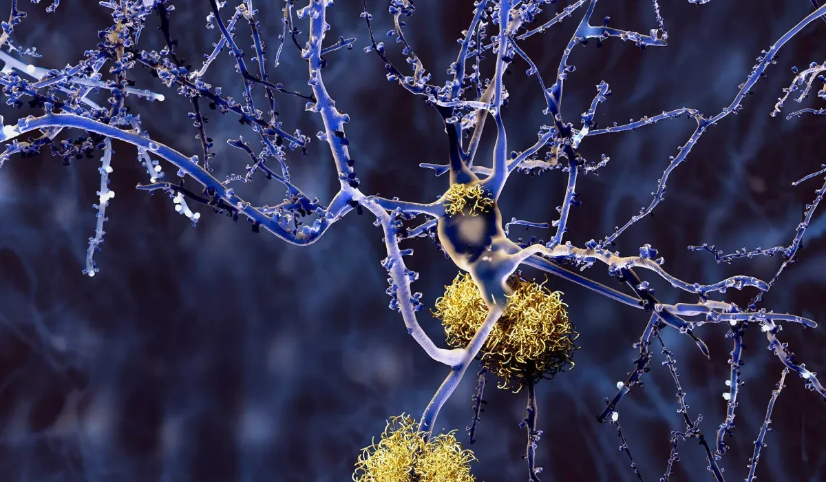 Essais Cliniques : Nouveau Vaccin et Médicament Oral Prometteurs contre la Maladie d'Alzheimer