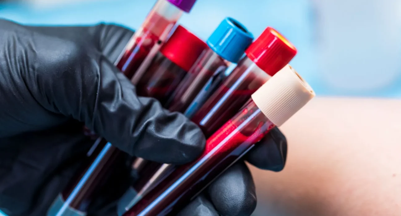 Microplastiques dans le sang humain : un lien avec un risque accru de caillots cérébraux