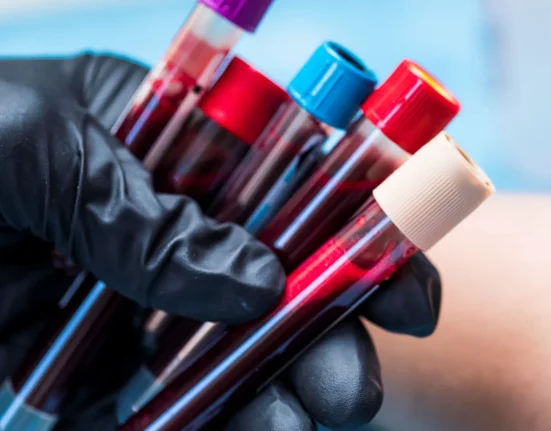 Microplastiques dans le sang humain : un lien avec un risque accru de caillots cérébraux