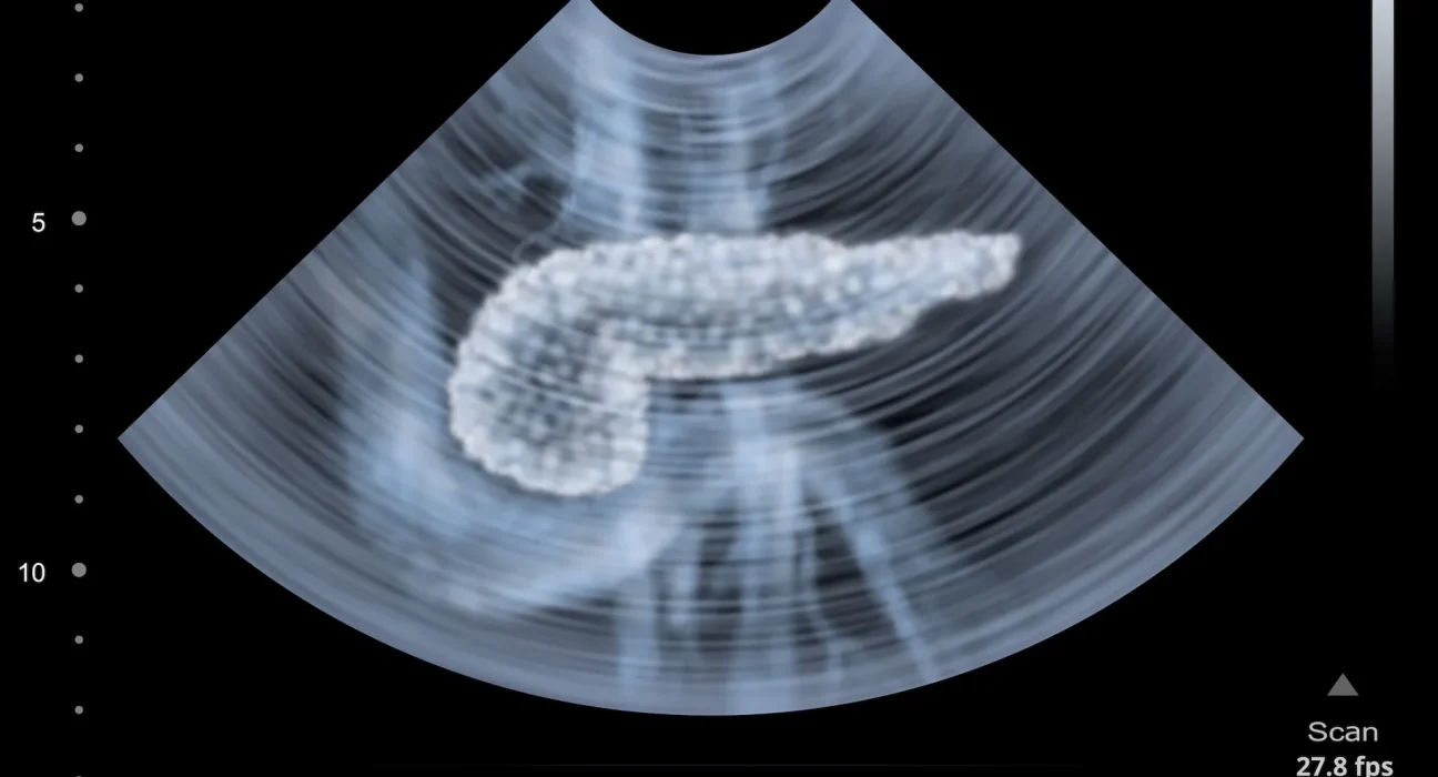 Nouvelle méthode révolutionnaire pour détecter le cancer du pancréas plus tôt, doublant ainsi les taux de survie.