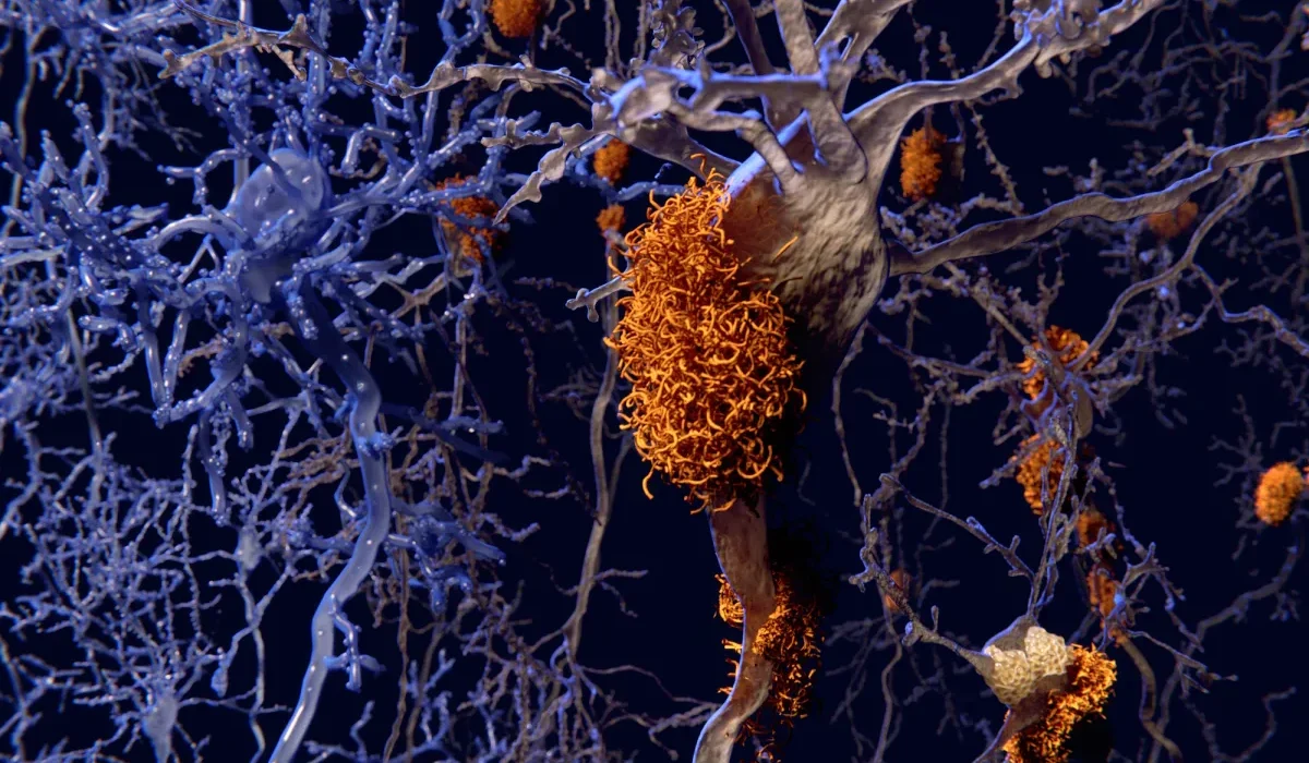 Transformations de Vie : La Clé pour Renversons Alzheimer, Pas une Pilule Magique.