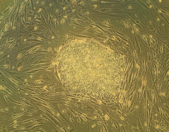 Un Médicament d'Immunothérapie Montré Comme Très Efficace Contre Une Complication Grave du Transplantation de Cellules Souches