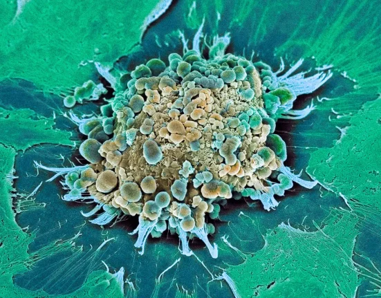 Un Nouveau Traitement du Cancer Pourrait Dépasser l'Efficacité de la Chimiothérapie.
