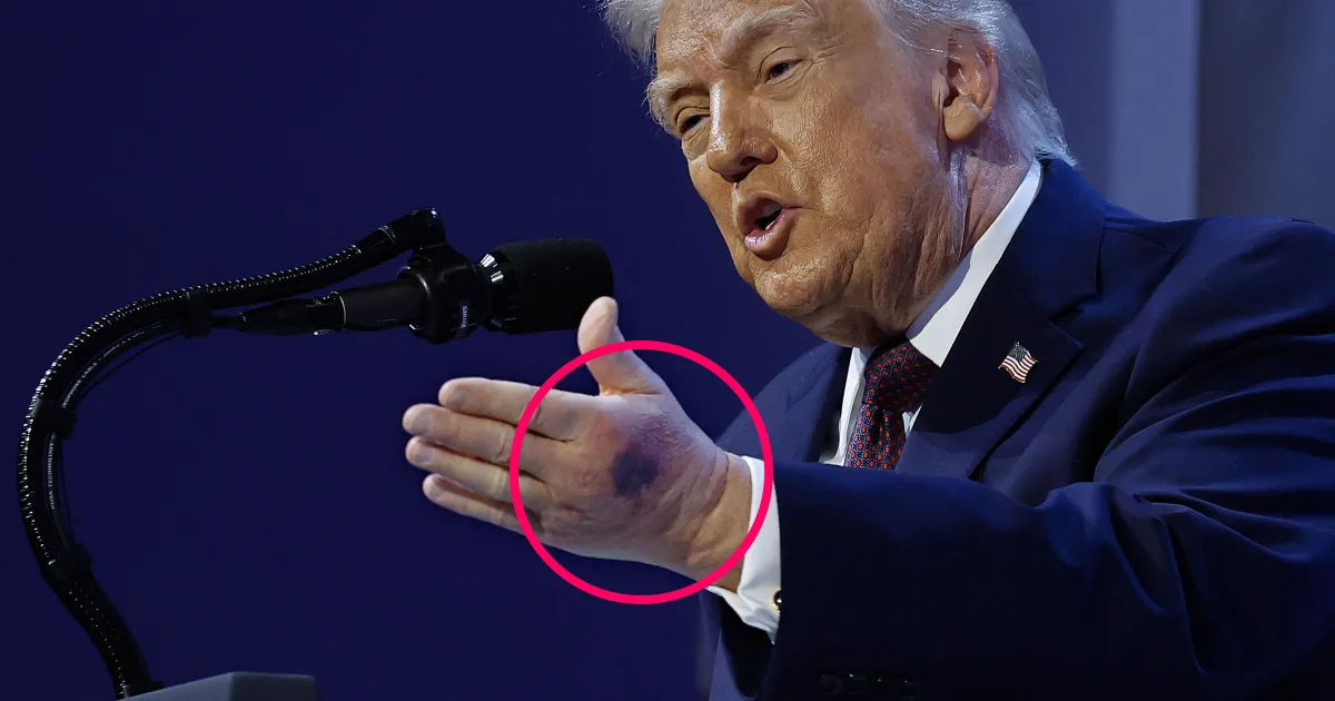 Une Marque Sinistre S'Affiche Également sur l'Autre Main de Trump