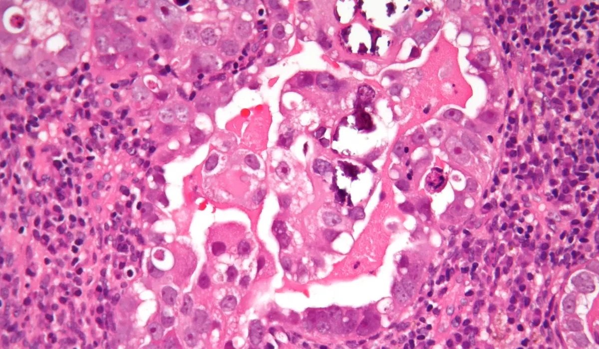 Une Nouvelle Thérapie Combat le Cancer Endométrial Grâce aux Nanoparticules.