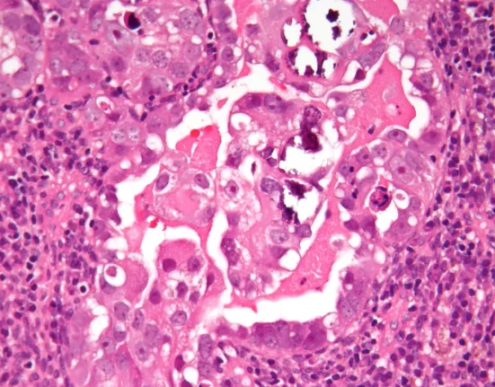 Une Nouvelle Thérapie Combat le Cancer Endométrial Grâce aux Nanoparticules.