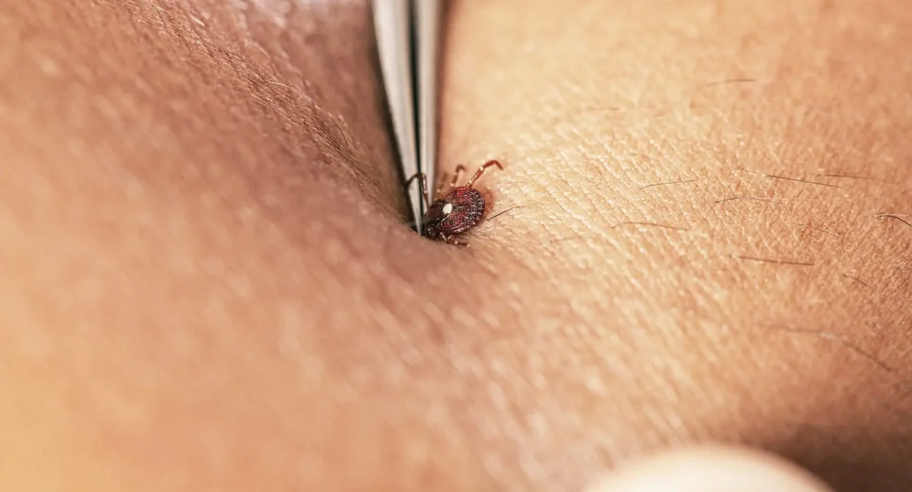 Une mutation vieille de 28 millions d'années pourrait éclairer la montée de l'allergie à la viande rouge aux États-Unis.