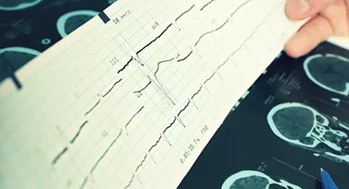 Des Greffes de Cellules Souches : Une Révolution dans le Traitement de la Sclérose En Plaques pour Renverser les Handicaps.