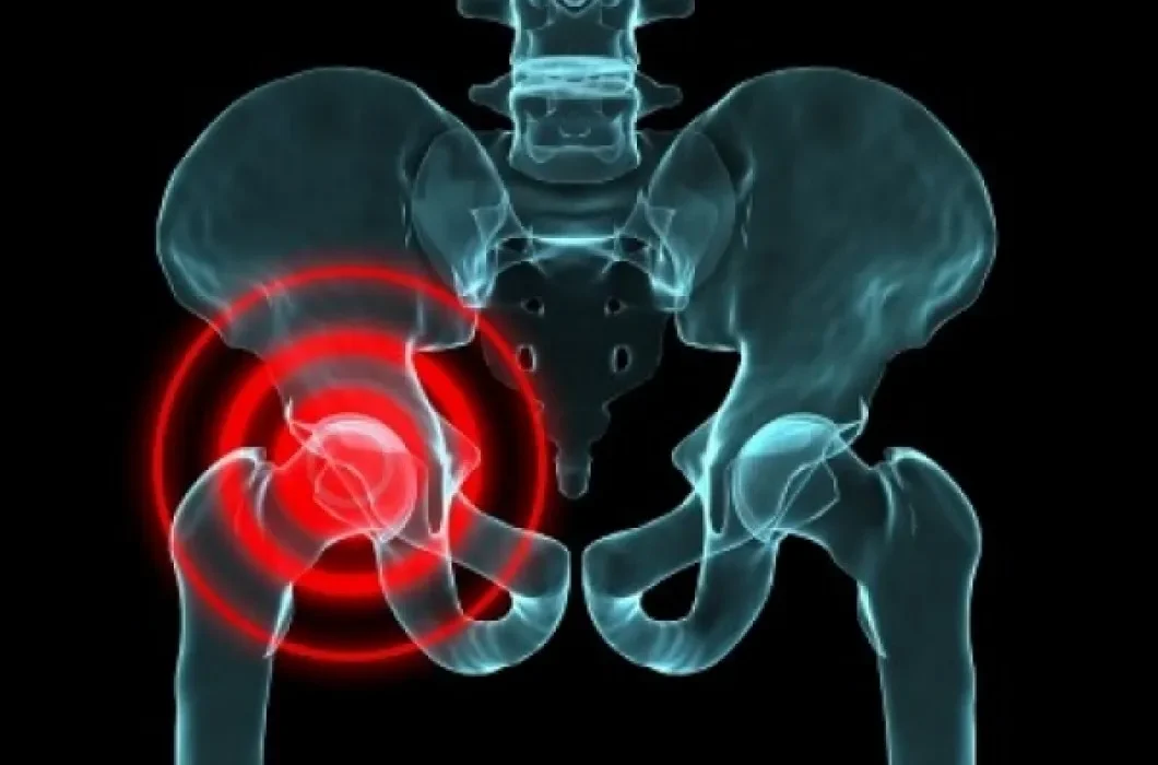Des Scientifiques Créent une "Hanche Vivante" Génétiquement Modifiée pour Soulager la Douleur.
