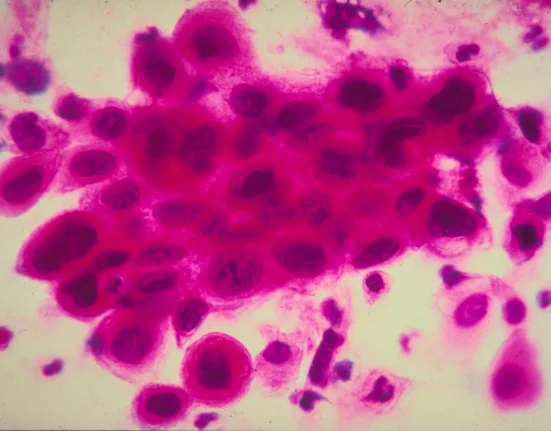 Éradiquer le Cancer à ses Racines : Un Nouveau Biosenseur Ultra-Sensible le Rend Possible.