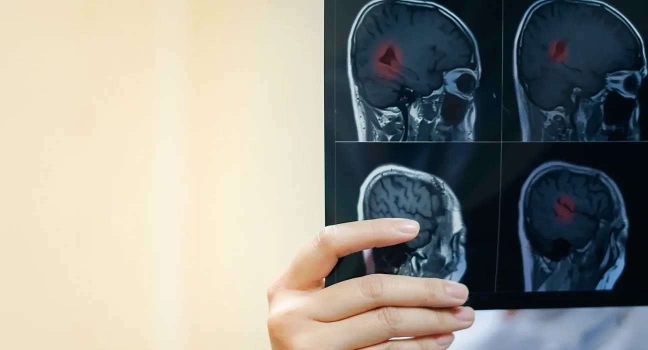 Implant cérébral sans fil : transmission directe des signaux visuels vers le cortex pour aider les personnes aveugles à percevoir la lumière et les formes.