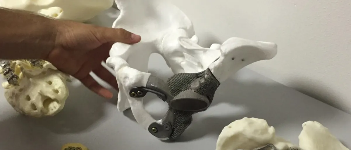 Impression 3D : La Révolution des Prothèses Osseuses pour Patients Cancéreux