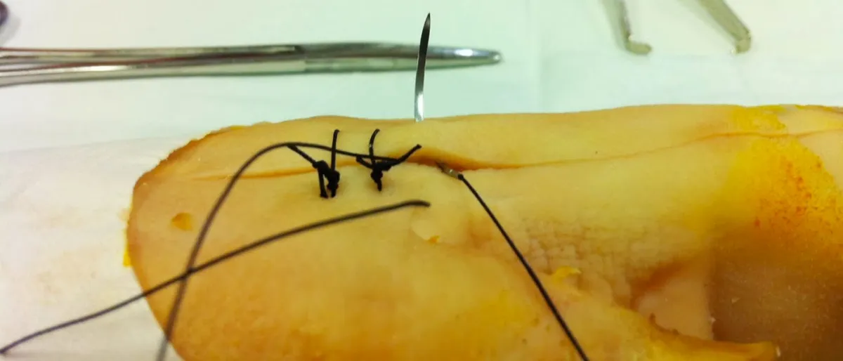 Les Sutures Intelligentes : Des Informations de Récupération Directes sur Votre Téléphone