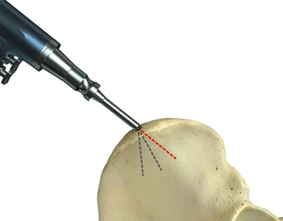 Nouvel Implant Biodegradable Prometteur pour Améliorer la Chirurgie de Remplacement Osseux