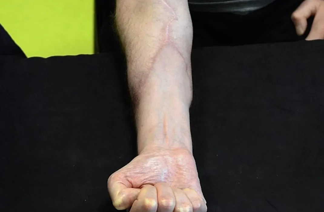 Première Mondiale : Un Pays Offrant des Transplants de Mains Gratuits
