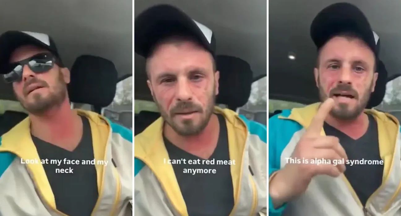 Réaction Alarmante : Un Homme Affrontant l'Allergie à la Viande Déclenchée par une Tique dans le Syndrome Alpha-Gal.