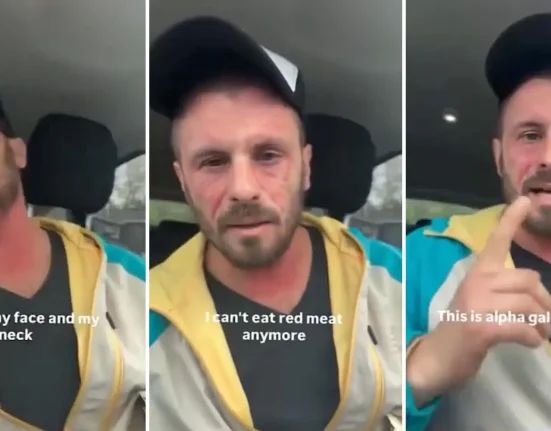 Réaction Alarmante : Un Homme Affrontant l'Allergie à la Viande Déclenchée par une Tique dans le Syndrome Alpha-Gal.